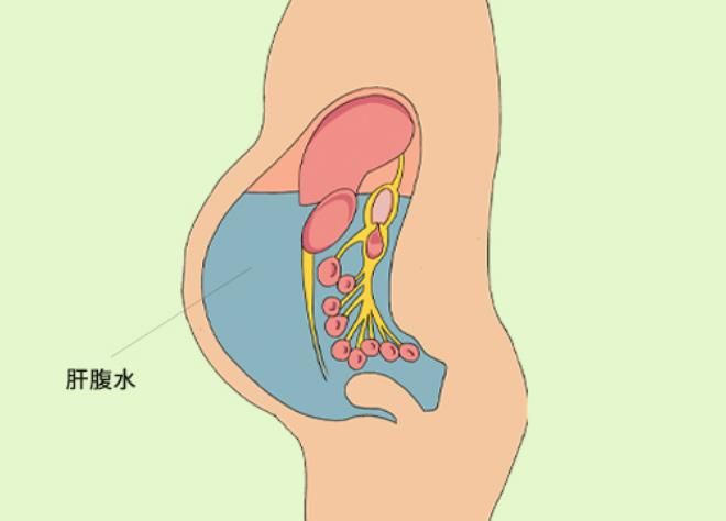 喉咙肿痛引发呼吸困难的紧急救援指南